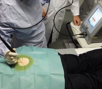 Foto einer Kryotherapie im Operationssaal